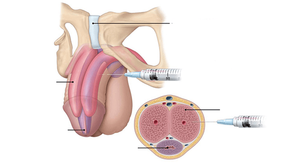 Injection of your own fatty tissue to measure penis thickness.