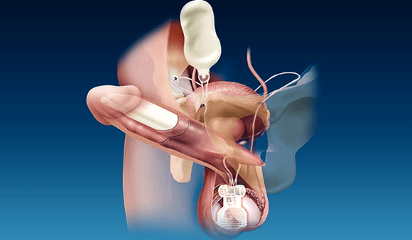 thick silicone and gel fillings